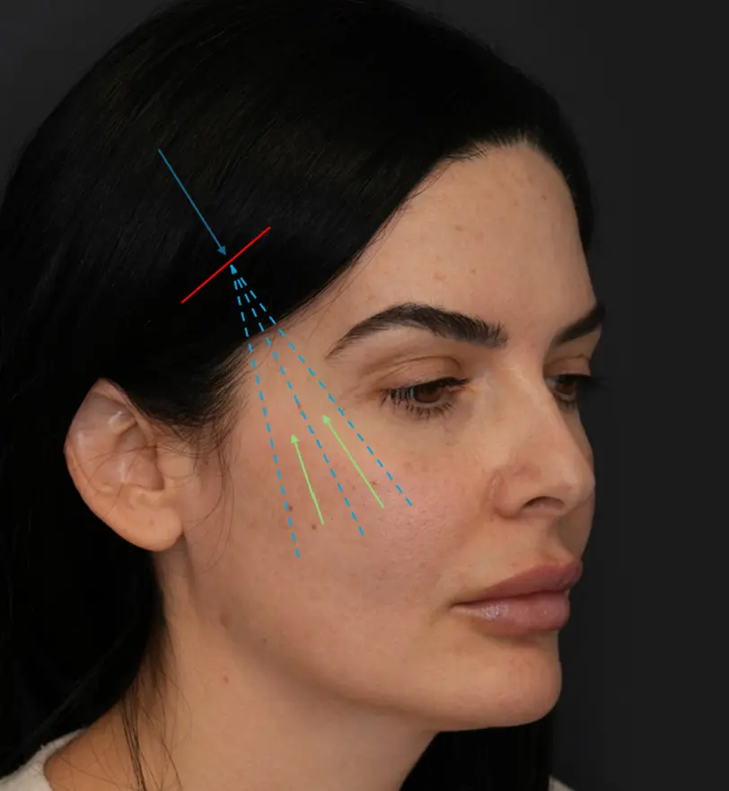 endoscopic facelift technique